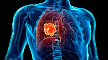 Argentina pone a disposición un nuevo tratamiento contra el cáncer de pulmón
