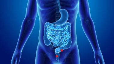 Se realiza la campaña de prevención de Cáncer de Colon
