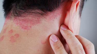Expertos Random: Psoriasis, una enfermedad que va más allá de la piel
