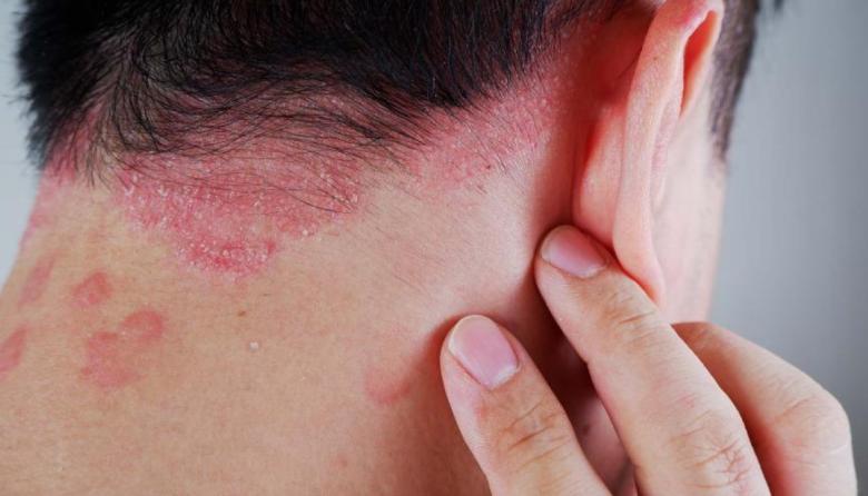 Expertos Random: Psoriasis, una enfermedad que va más allá de la piel