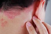 Expertos Random: Psoriasis, una enfermedad que va más allá de la piel